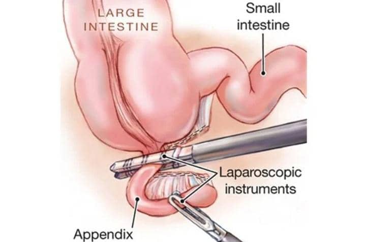 How Delayed Appendicitis Surgery May Lead to Infection, Death